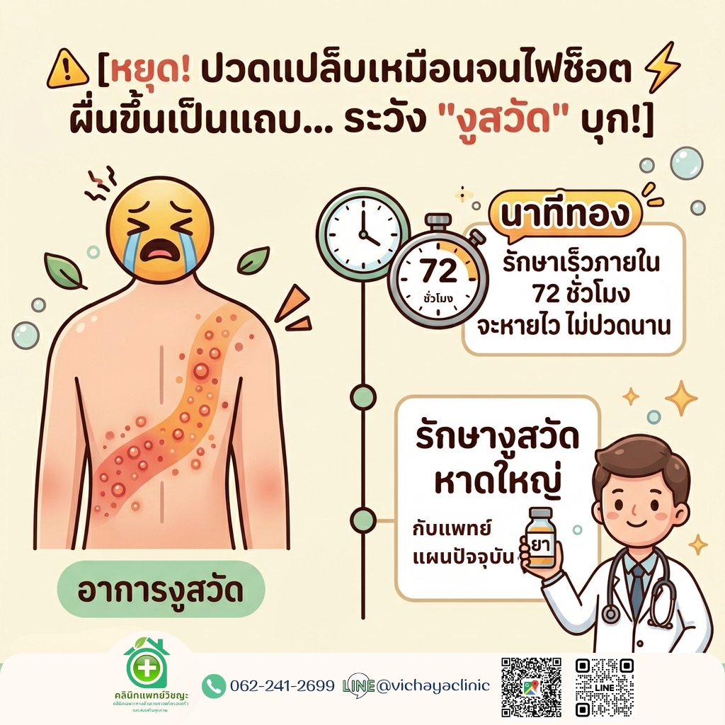 อินโฟกราฟิกโรคงูสวัด นาทีทอง 72 ชั่วโมง รักษางูสวัดหาดใหญ่ กับแพทย์แผนปัจจุบัน คลินิกแพทย์วิชญะ ปวดแสบร้อนแปลบเหมือนไฟช็อต